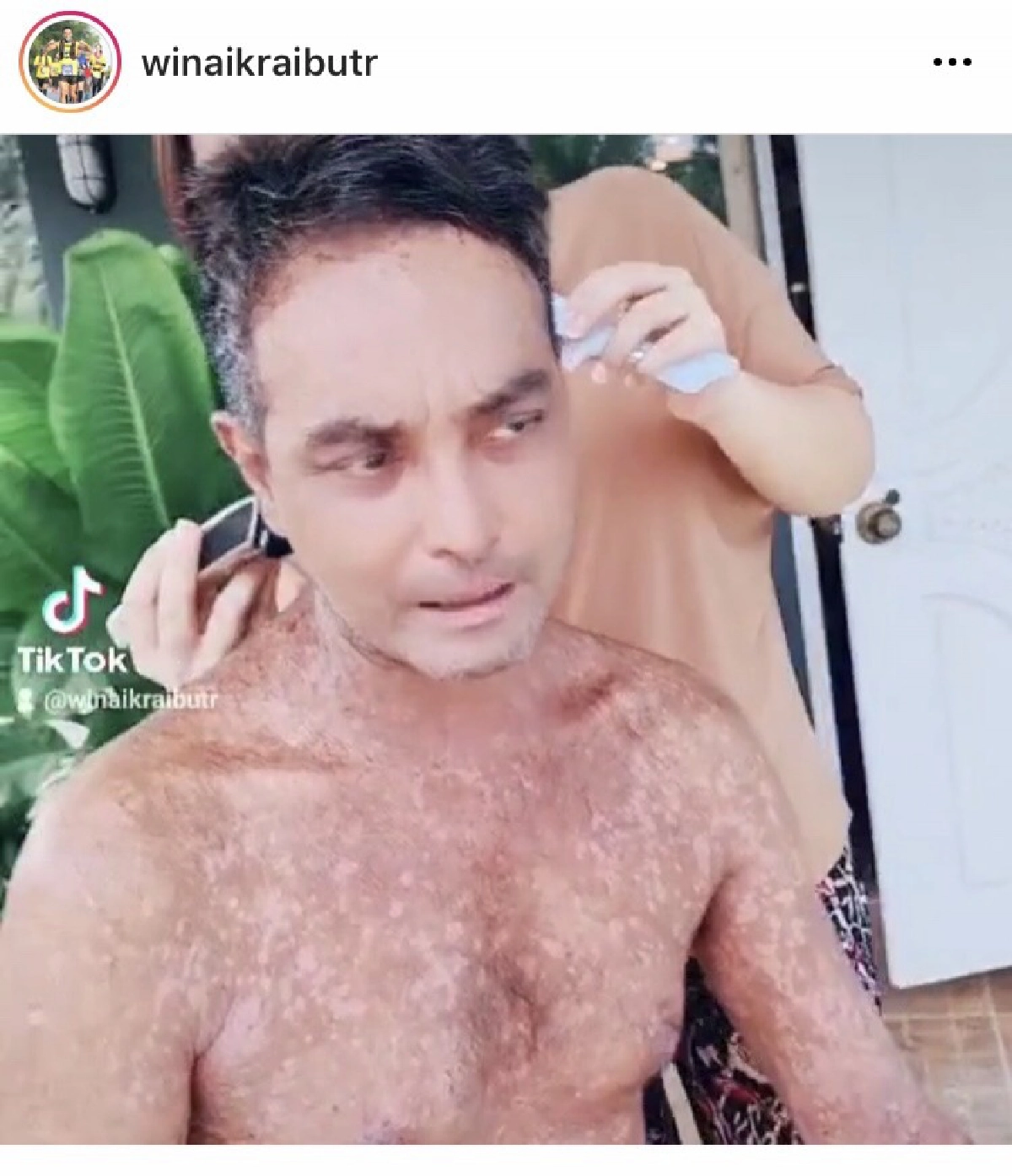 "วินัย ไกรบุตร" ยังยิ้มได้ แม้โรคตุ่มน้ำพองกำเริบ มีเมีย-ลูก เป็นกำลังใจ