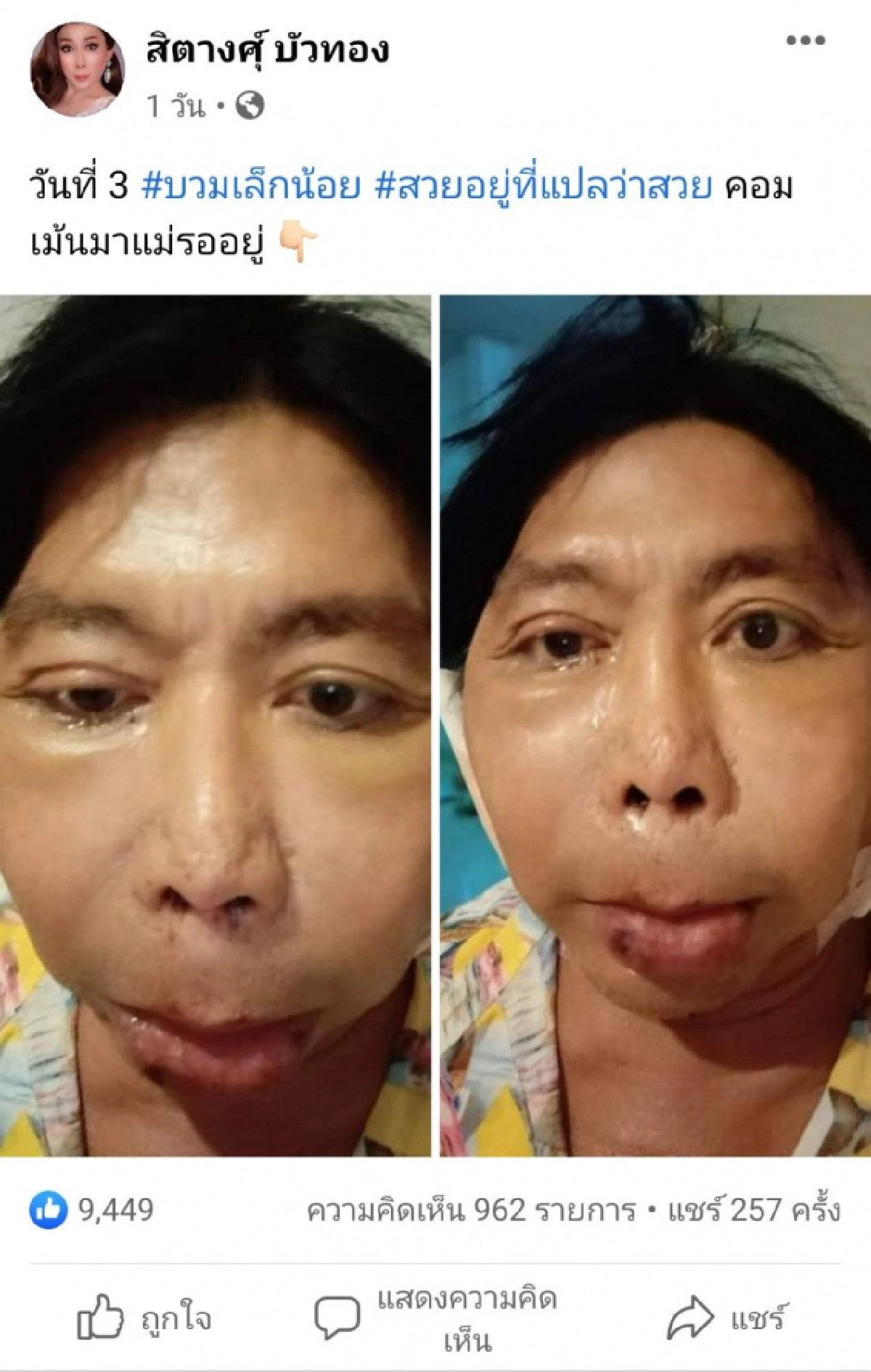 ส่องใบหน้า "สิตางศุ์ บัวทอง"อัปเดตศัลยกรรมวันที่ 4  ลั่น "ฉันร้องกรี๊ดเลย"