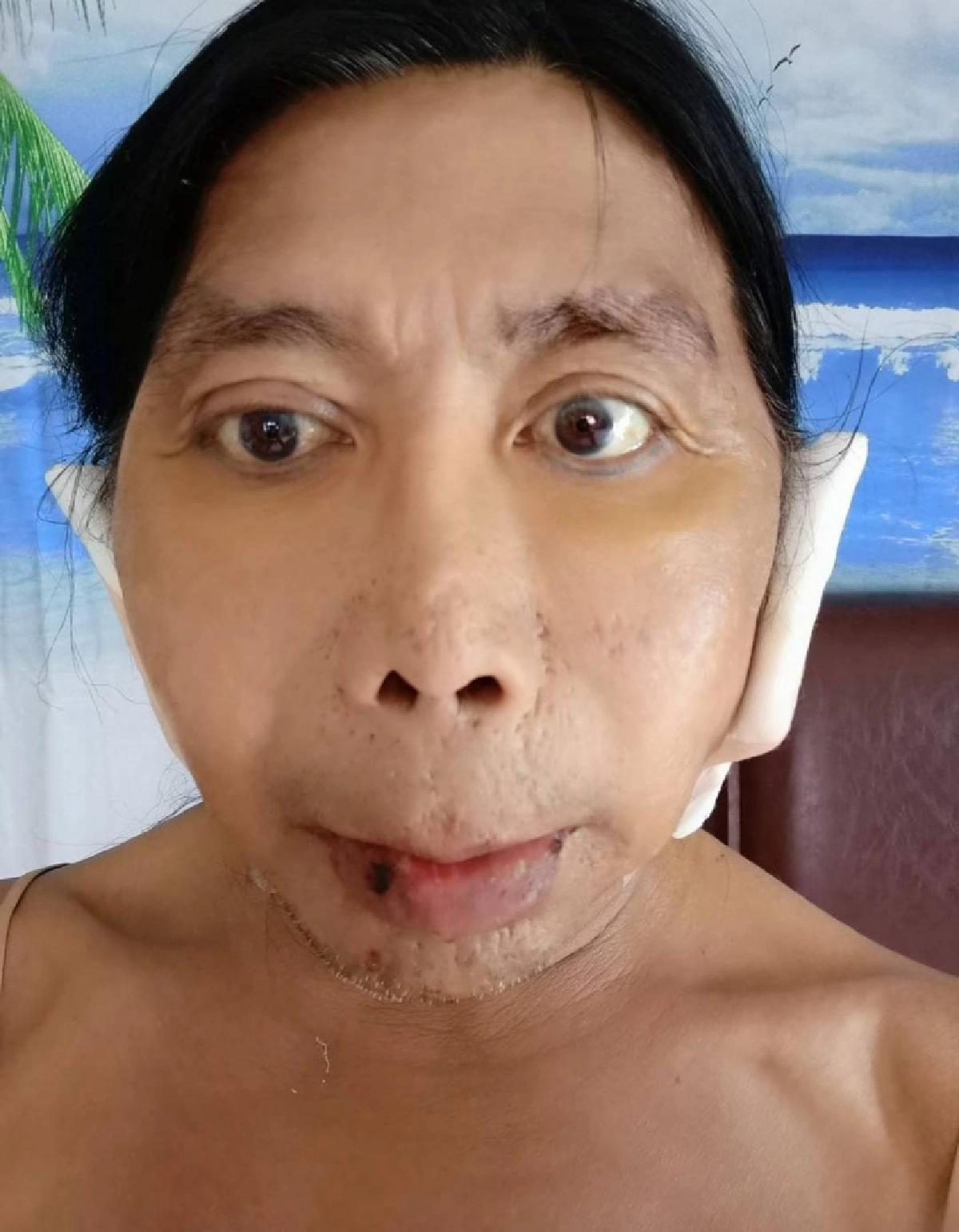 ส่องใบหน้า "สิตางศุ์ บัวทอง"อัปเดตศัลยกรรมวันที่ 4  ลั่น "ฉันร้องกรี๊ดเลย"