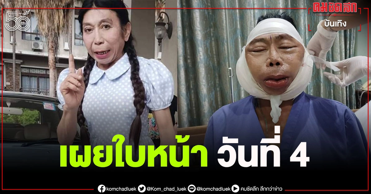 ส่องใบหน้า "สิตางศุ์ บัวทอง"อัปเดตศัลยกรรมวันที่ 4  ลั่น "ฉันร้องกรี๊ดเลย"