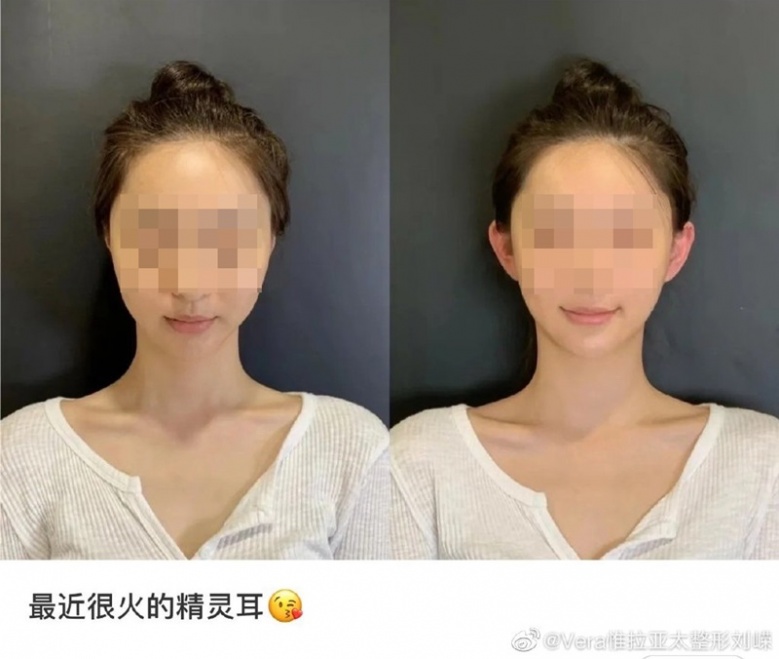 วัยรุ่นจีนแห่ทำศัลยกรรม "หูเอลฟ์" เสริมความสวยหล่อ เชื่อ ช่วยให้หน้าดูเรียวเล็ก-เด็กลง