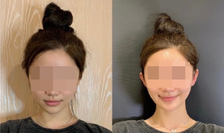 วัยรุ่นจีนแห่ทำศัลยกรรม "หูเอลฟ์" เสริมความสวยหล่อ เชื่อ ช่วยให้หน้าดูเรียวเล็ก-เด็กลง