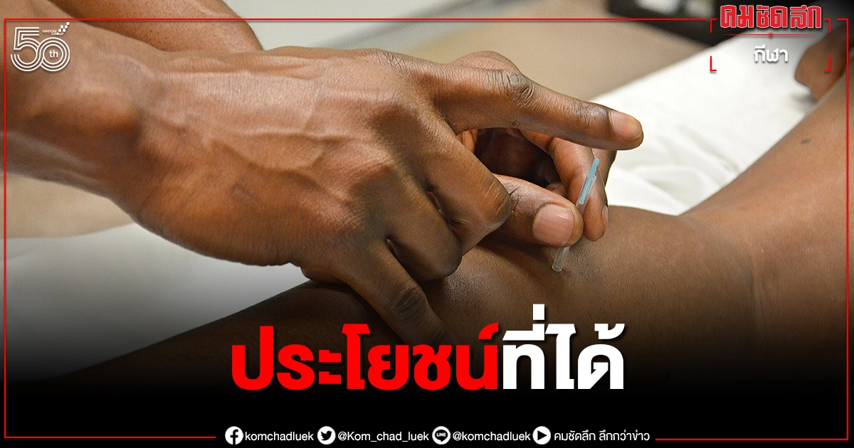 "ฝังเข็ม"(แล้ว) ได้อะไร