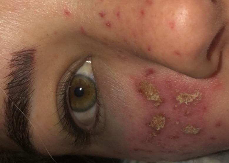 เตือนภัย สาวอยาก "หน้ามีกระ" ผิวดูฉ่ำแดดเก๋ๆ ระวังหน้าพัง หากทำตามวิธีผิดๆ