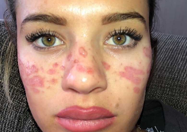 เตือนภัย สาวอยาก "หน้ามีกระ" ผิวดูฉ่ำแดดเก๋ๆ ระวังหน้าพัง หากทำตามวิธีผิดๆ