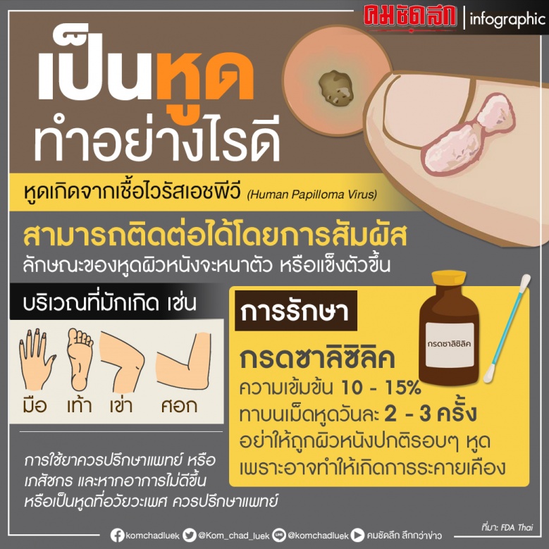 หูด, กรดซาลิซิลิค, เชื้อไวรัสเอชพีวี