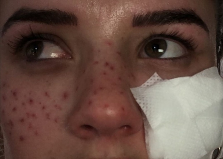 เตือนภัย สาวอยาก "หน้ามีกระ" ผิวดูฉ่ำแดดเก๋ๆ ระวังหน้าพัง หากทำตามวิธีผิดๆ