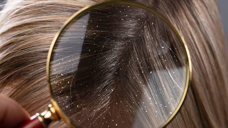 หมดปัญหารังแค แก้ด้วย 6 วิธี แบบธรรมชาติ