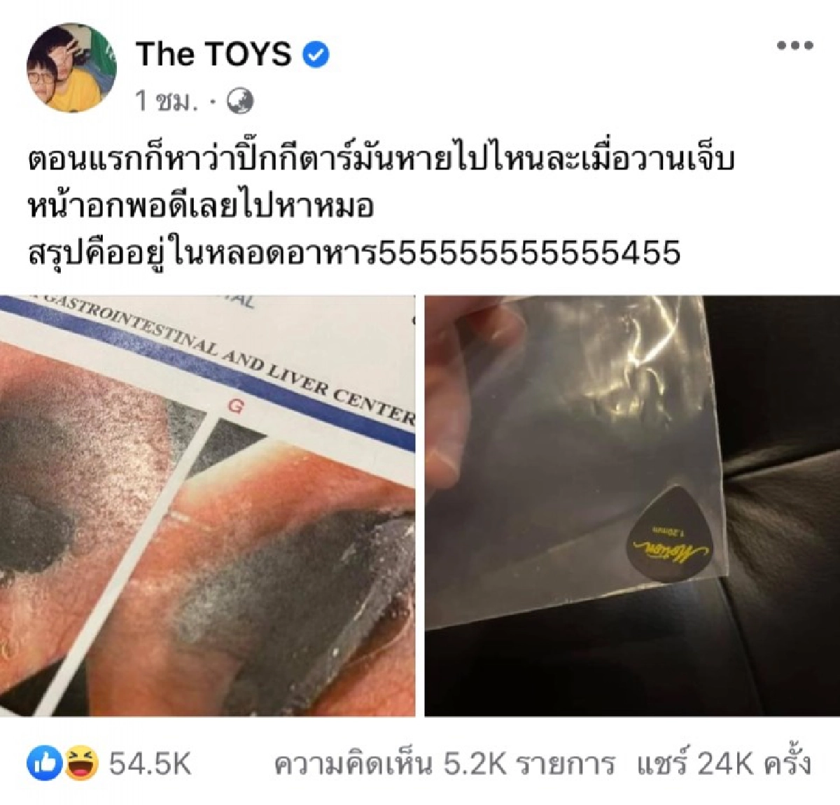 งงหนัก "เดอะทอยส์" ตามหาปิ๊กกีต้าร์ สุดท้ายอยู่ในหลอดอาหาร