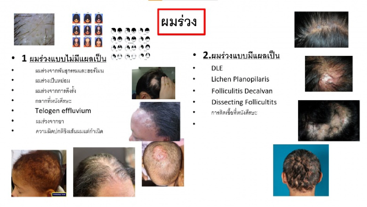 5 เทคนิค ดูแล "เส้นผมหลุดร่วง" และ "หนังศีรษะอักเสบ"ด้วยตัวเอง 