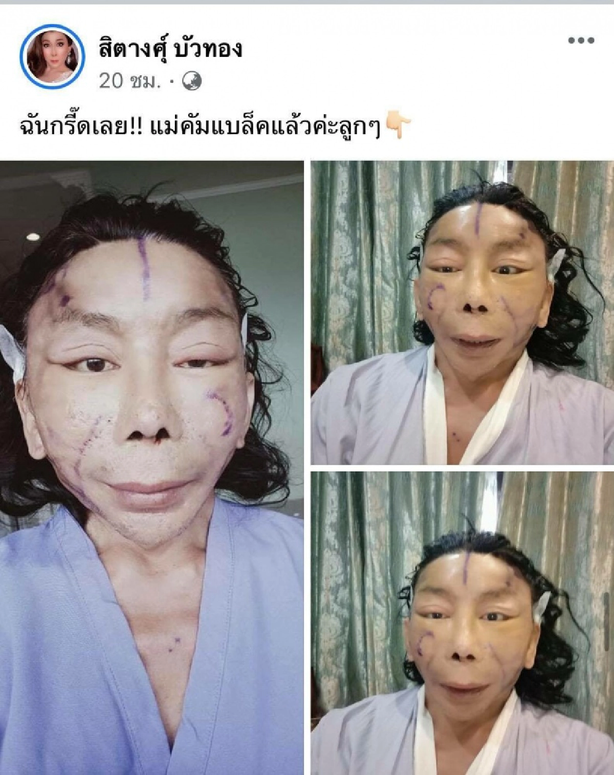 "สิตางศุ์ บัวทอง" ปิดตำนานหน้าผี เผยโฉมแรก หลังผ่าตัดดึงหน้า