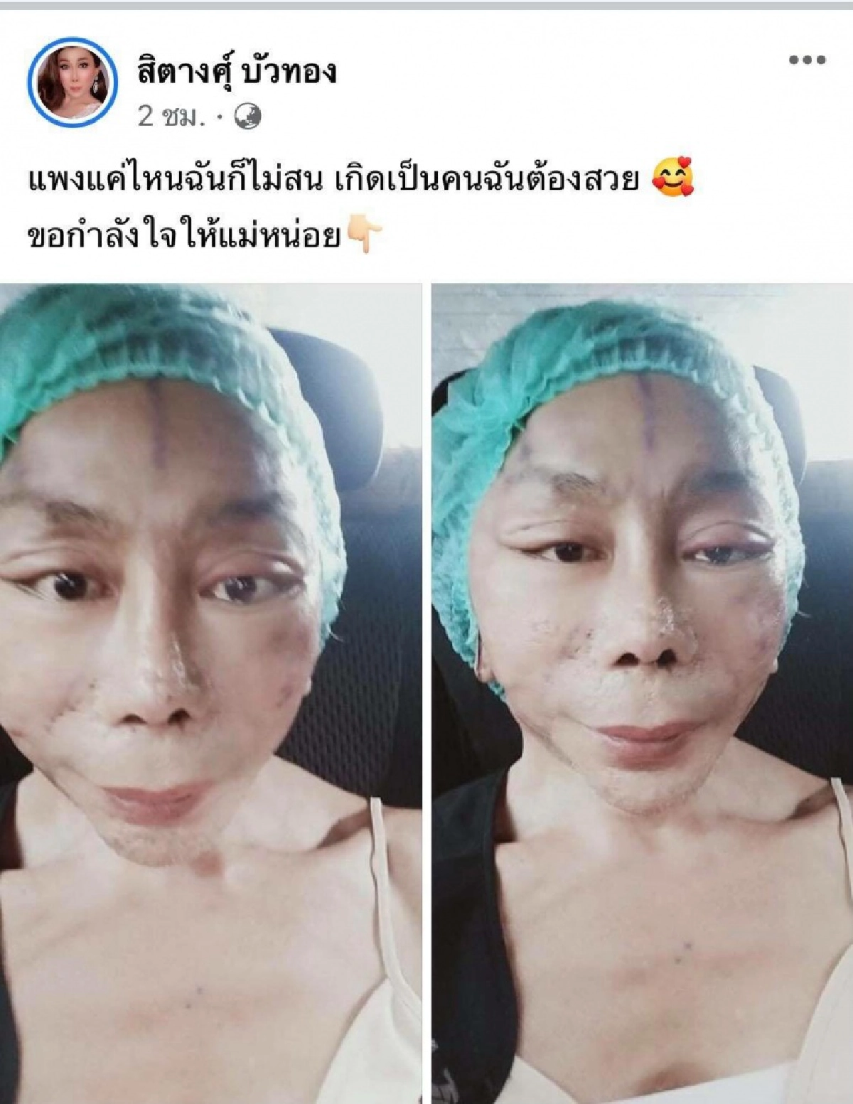 "สิตางศุ์ บัวทอง" ปิดตำนานหน้าผี เผยโฉมแรก หลังผ่าตัดดึงหน้า