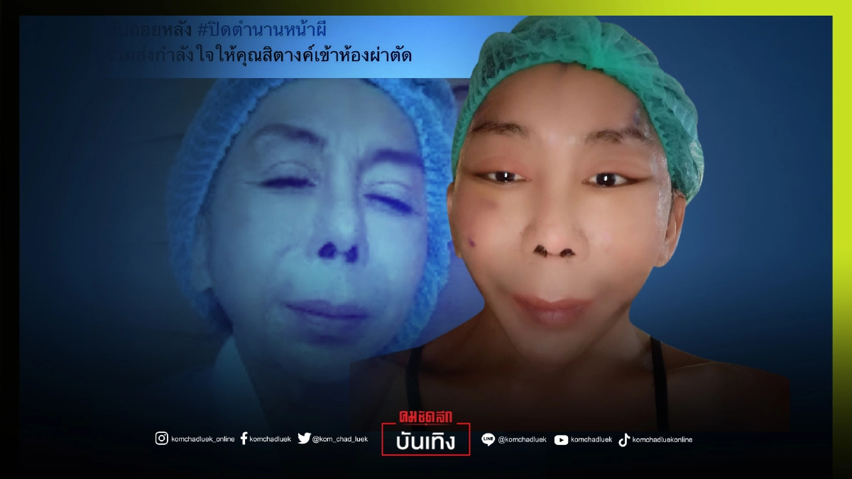 "สิตางศุ์ บัวทอง" ปิดตำนานหน้าผี เผยโฉมแรก หลังผ่าตัดดึงหน้า "สิตางศุ์ บัวทอง" ปิดตำนานหน้าผี เผยโฉมแรก หลังผ่าตัดดึงหน้า