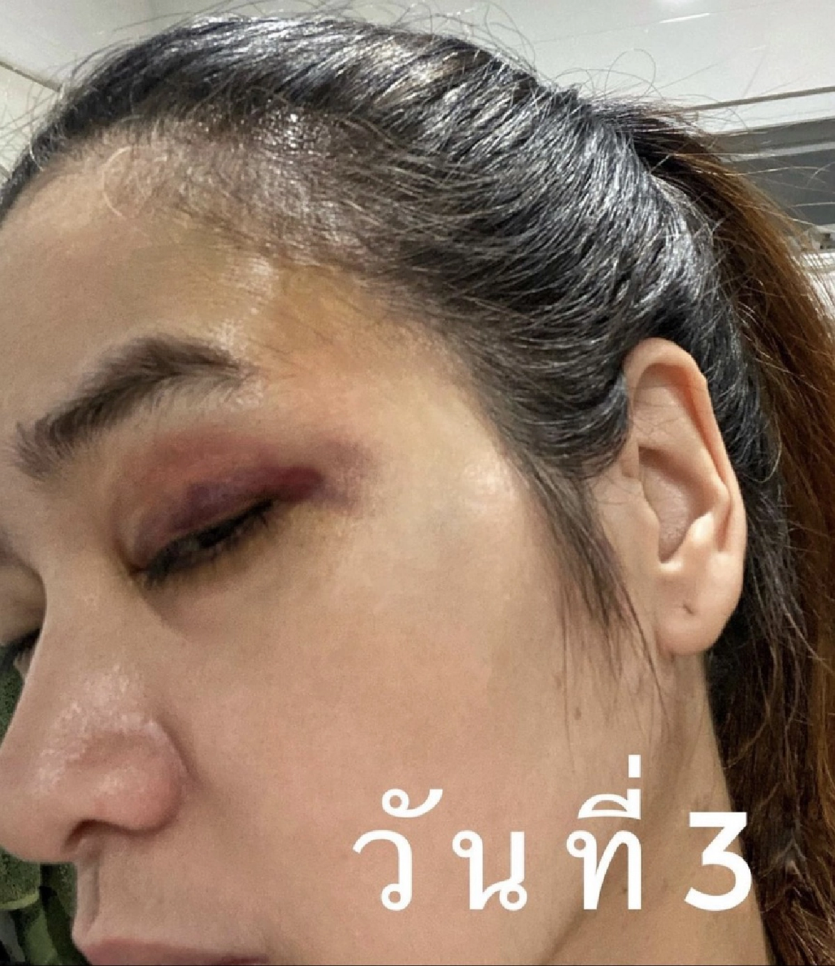 "ปอย ปวีณา" โพสต์ภาพใบหน้าช้ำ เหตุเล่นสเก็ตบอร์ด