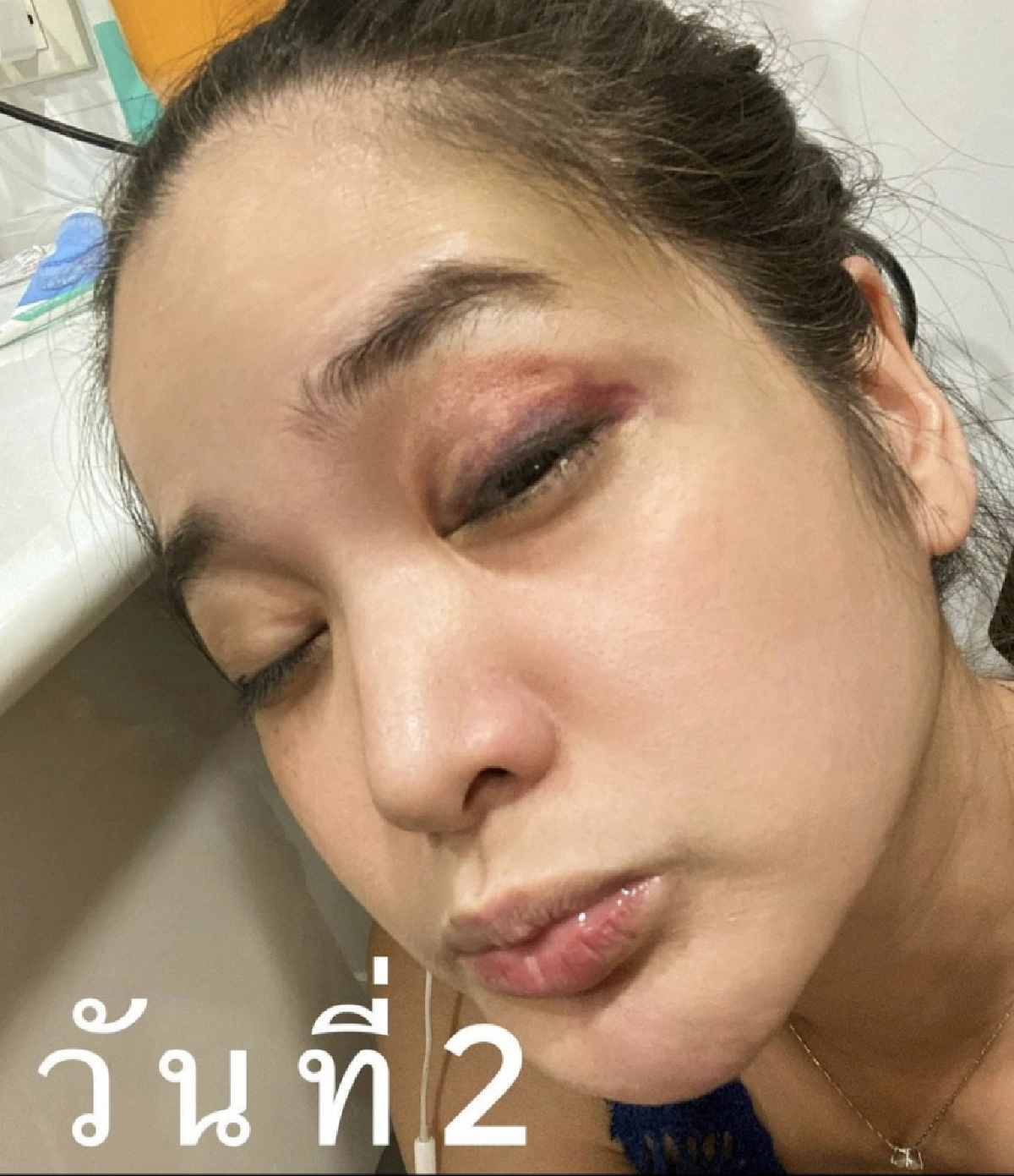 "ปอย ปวีณา" โพสต์ภาพใบหน้าช้ำ เหตุเล่นสเก็ตบอร์ด