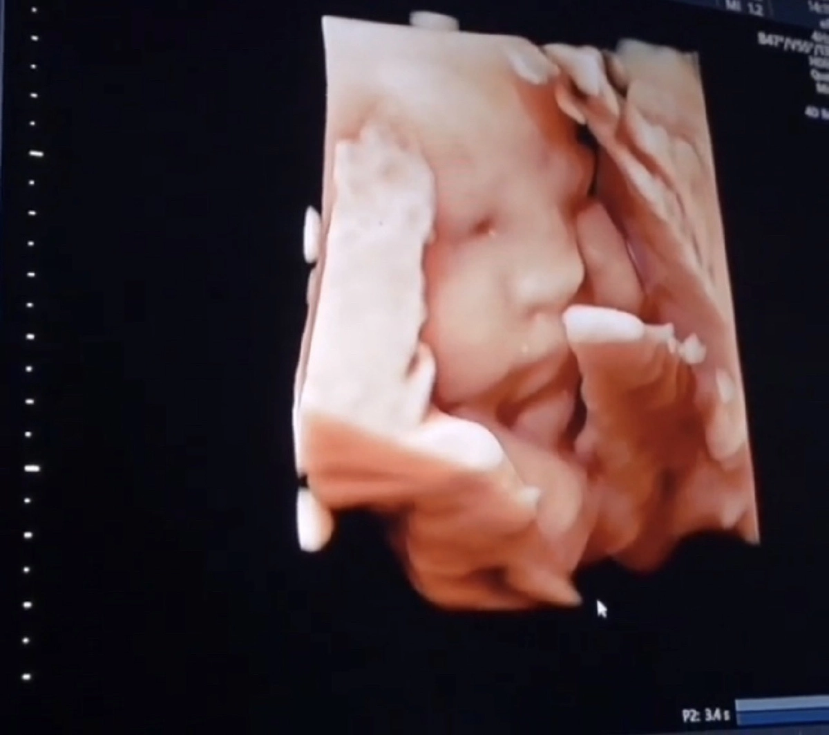 "โย่ง อาร์มแชร์"  โชว์ภาพอัลตราซาวด์ ลูกสาวคนแรก หลังครบ 32 สัปดาห์