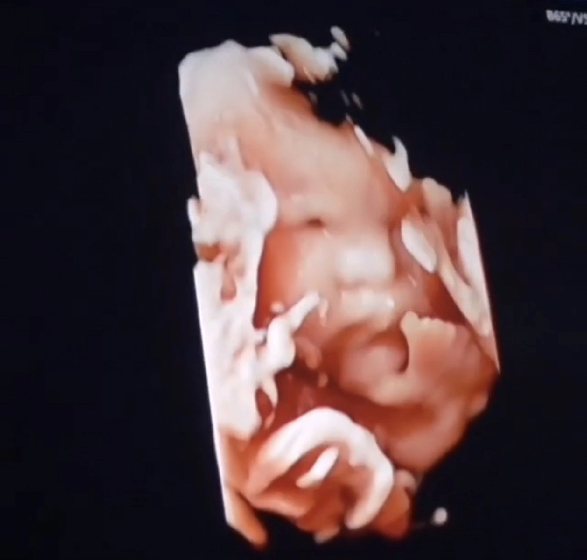 "โย่ง อาร์มแชร์"  โชว์ภาพอัลตราซาวด์ ลูกสาวคนแรก หลังครบ 32 สัปดาห์