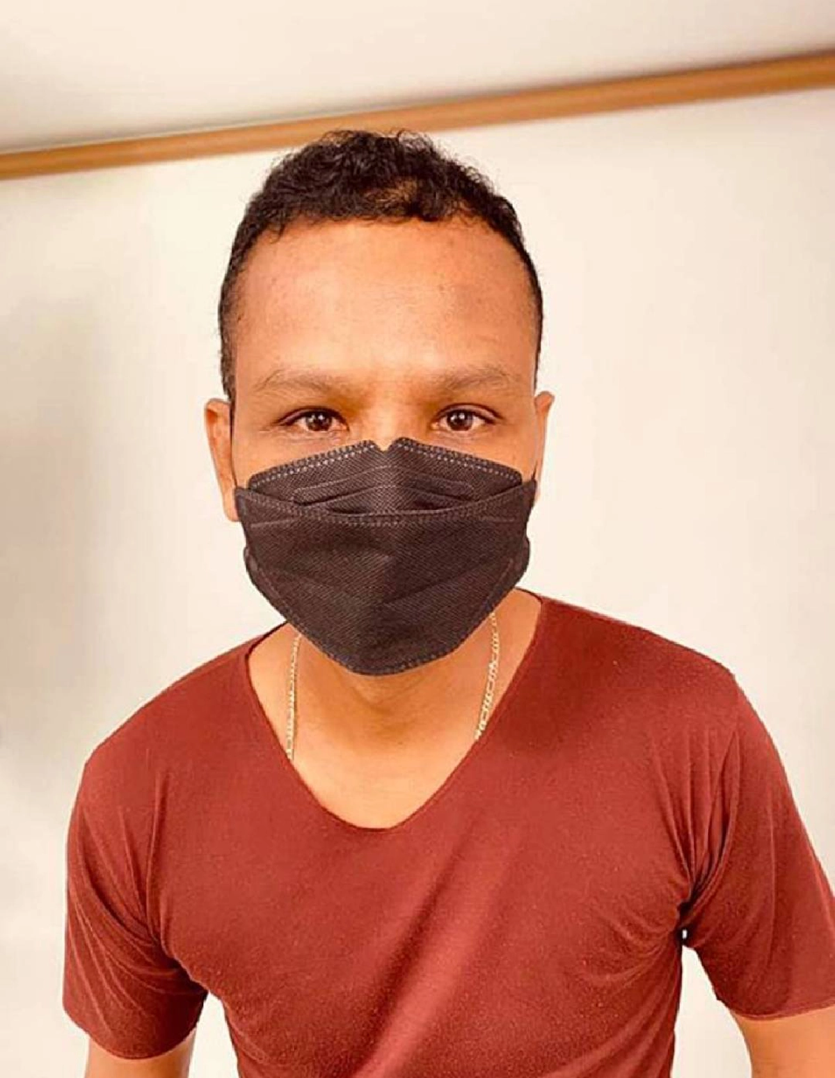 ภาพล่าสุดหน้าหลังศัลยกรรม