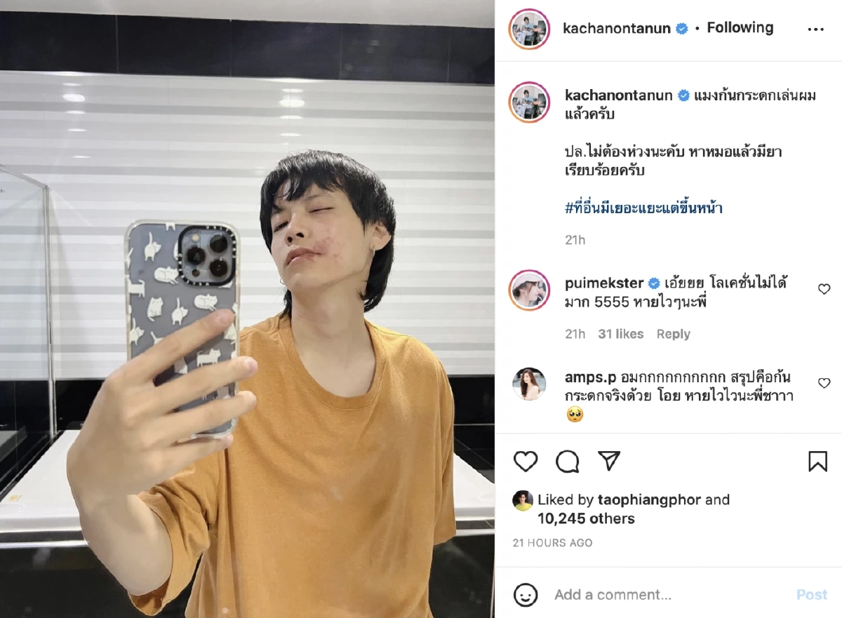 สภาพ "คชา นนทนันท์" โพสต์รูปน่าตกใจ หลังถูกพิษแมลงก้นกระดก