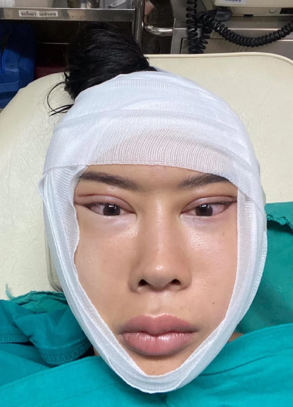 เสพติดศัลยกรรม "น้ำเพชร" หน้าย้วย ทุ่มเงินเรือนแสน ซ่อมหน้า