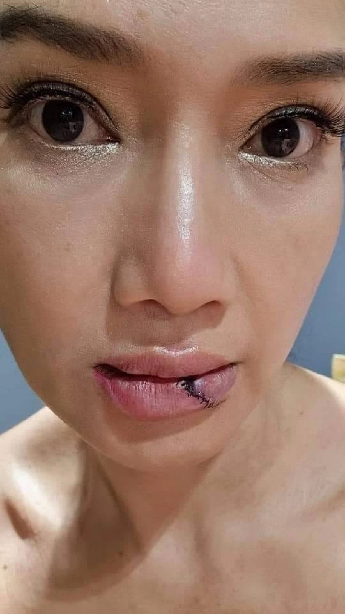 นักแสดงรุ่นใหญ่ "ดี้ ชนานา" ประสบอุบัติเหตุ รถไถลชนเสาไฟฟ้า ต้องเย็บด่วน