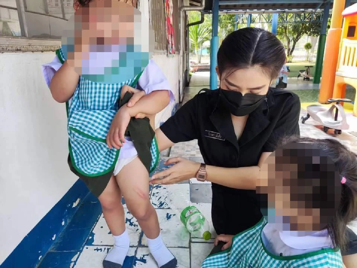 แม่สุดทน แจ้งจับ "พี่เลี้ยง"  ตีลูกสาววัย 2 ขวบ เป็นรอยแผลเขียวช้ำทั่วตัว