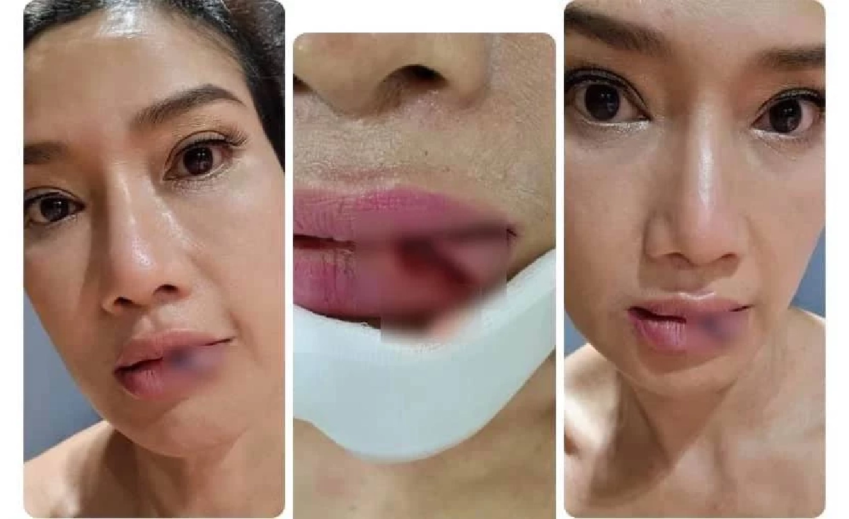 นักแสดงรุ่นใหญ่ "ดี้ ชนานา" ประสบอุบัติเหตุ รถไถลชนเสาไฟฟ้า ต้องเย็บด่วน