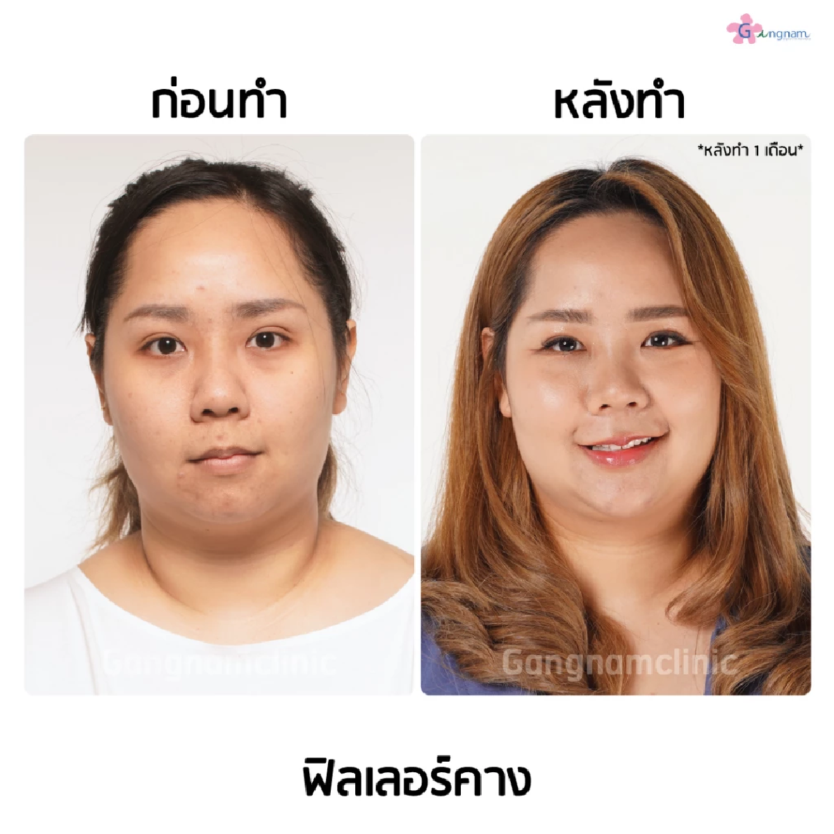 ฟิลเลอร์คาง