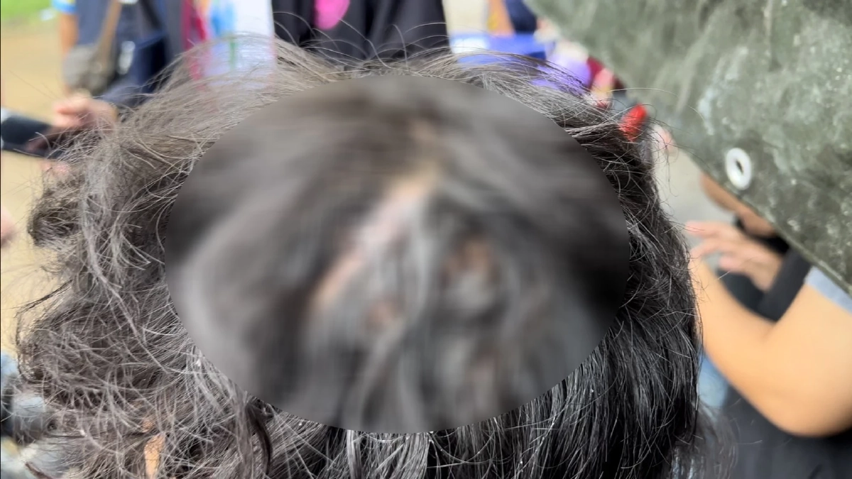 ด.ญ.วัย 14 สุดทน โดน "แม่เลี้ยง" ทำร้าย ตีหัวแตก แผลทั่วตัว  หนีจากบ้านกลางดึก