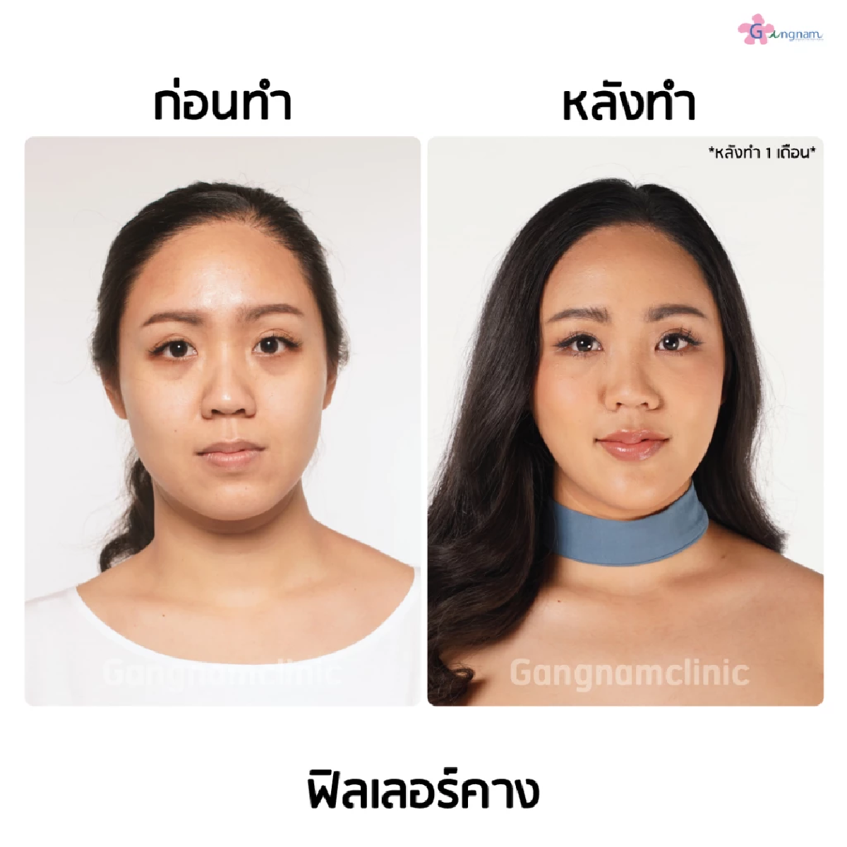 ฟิลเลอร์คาง