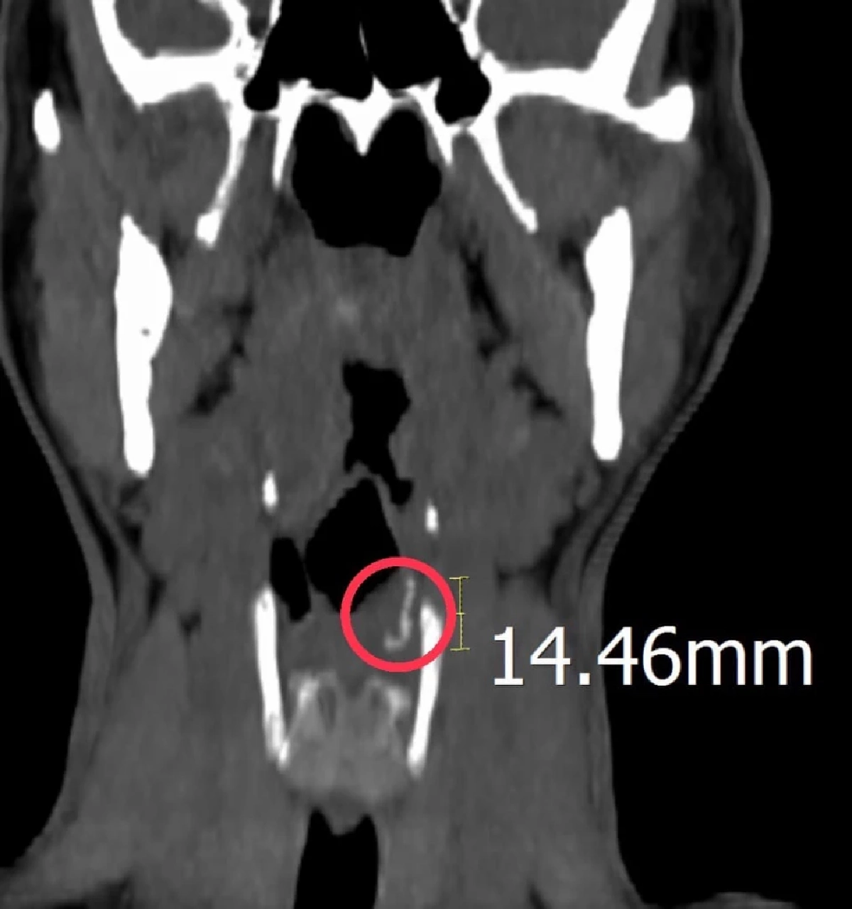 สิ่งแปลกปลอมในลำคอ