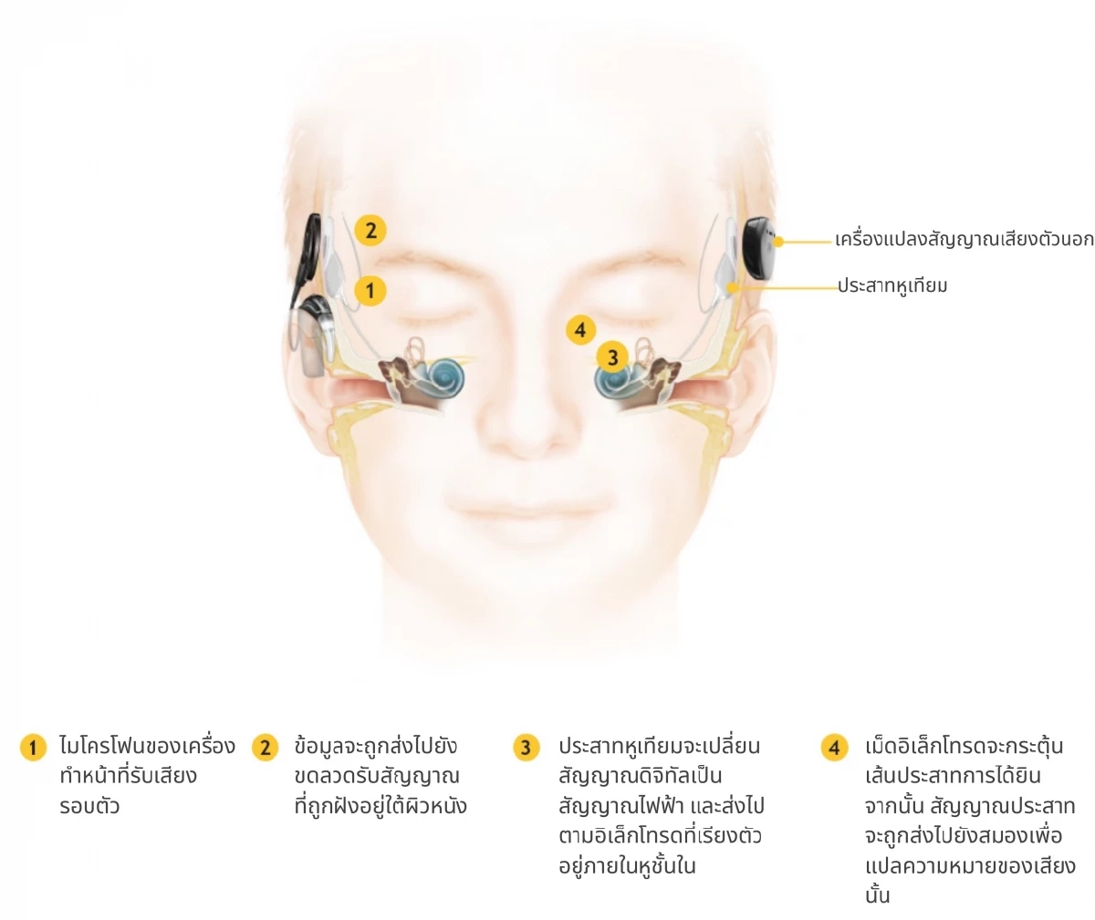 ภาพการทำงานของประสาทหูเทียม