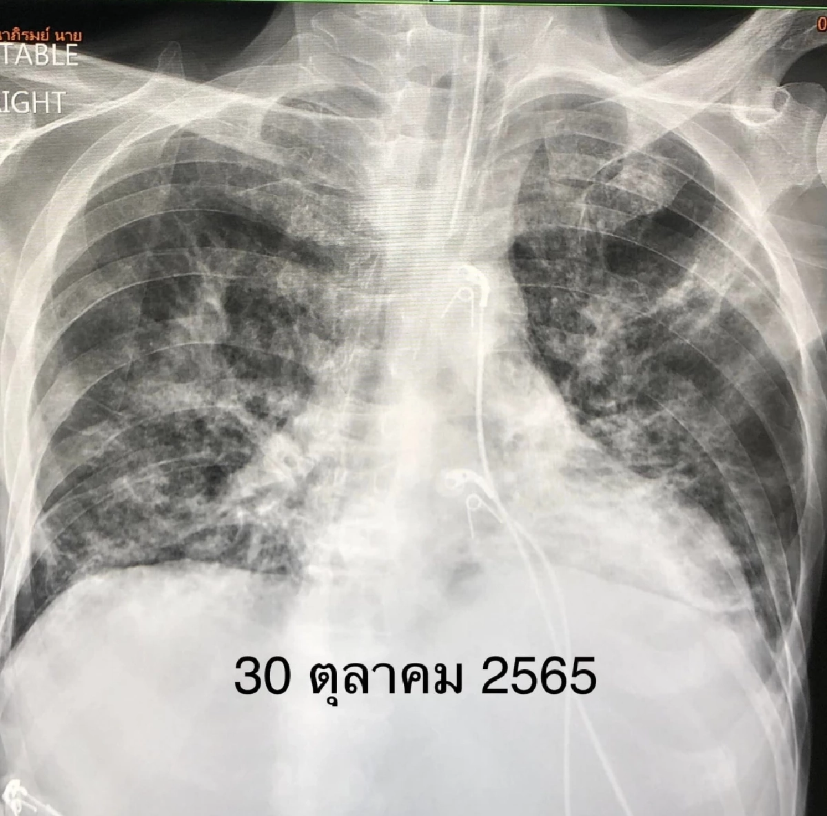 ภาพเอกซเรย์ปอด