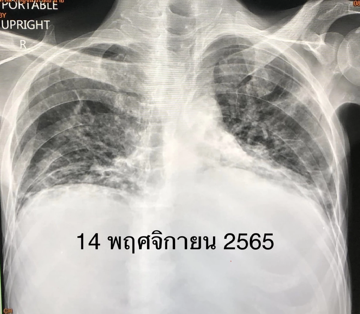 ภาพเอกซเรย์ปอด