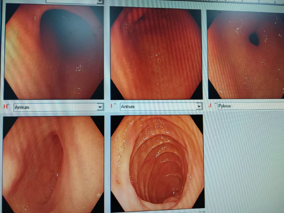 ภาพขณะส่องกล้องกระเพาะอาหาร