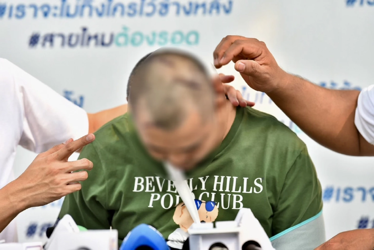 รปภ.หนุ่ม ร้องสายไหมต้องรอด โดนเพื่อนร่วมงานฟันนิ้วขาด 