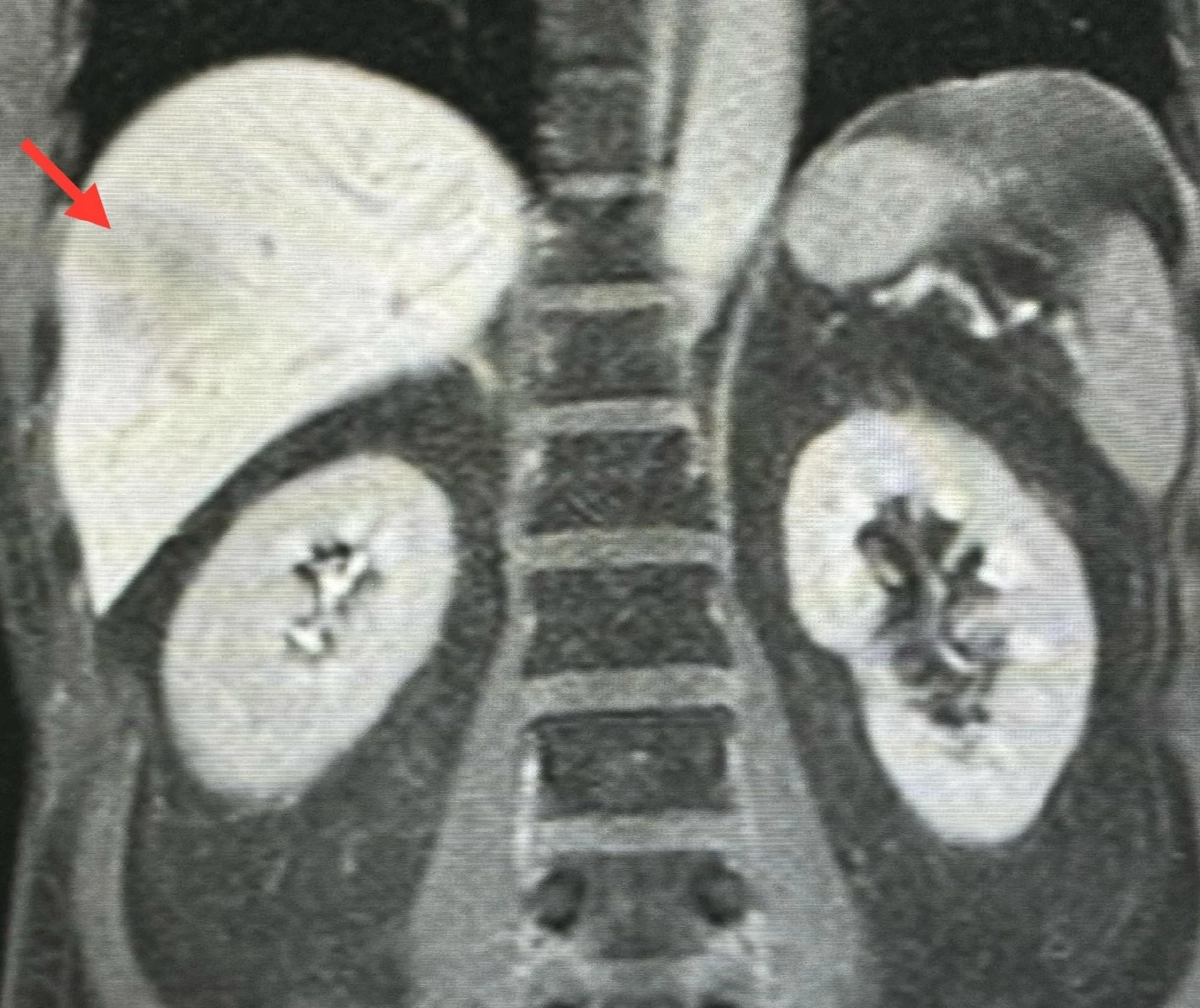 ฝีในตับ