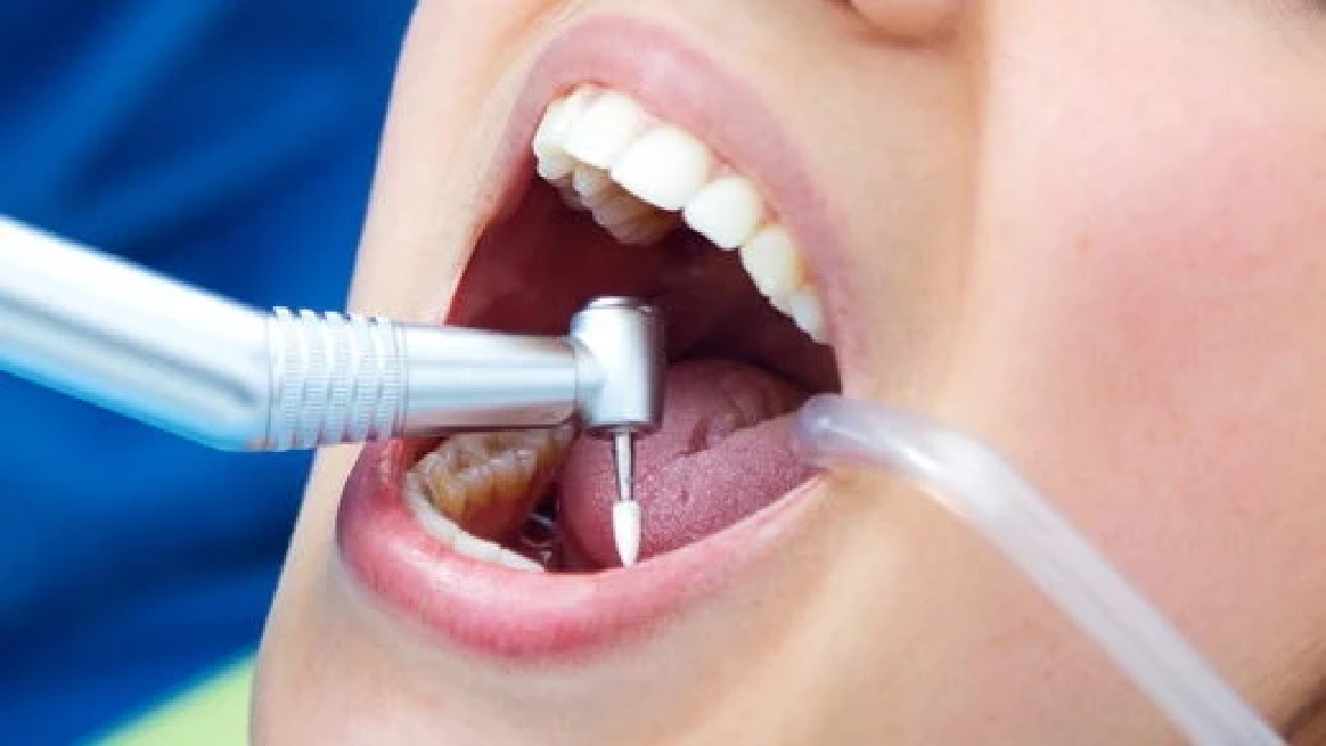 อย่าหาทำ!  อุดฟัน DIY อาจติดเชื้อ อักเสบในโพรงฟัน ลุกลามจนต้องถอนทิ้ง