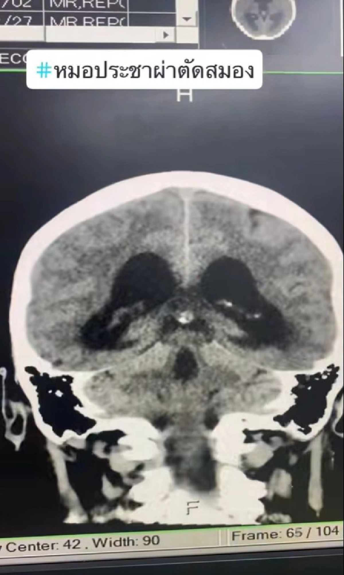 .อันตรายถึงตาย! หมอประชา  เตือน พักผ่อนน้อย เครียด ภูมิต้านทานต่ำอันตรายถึงตาย เสี่ยงเริมขึ้นสมอง ยกเคสผู้ป่วยเป็นกรณีศึกษา เช็กอาการด่วนๆ .