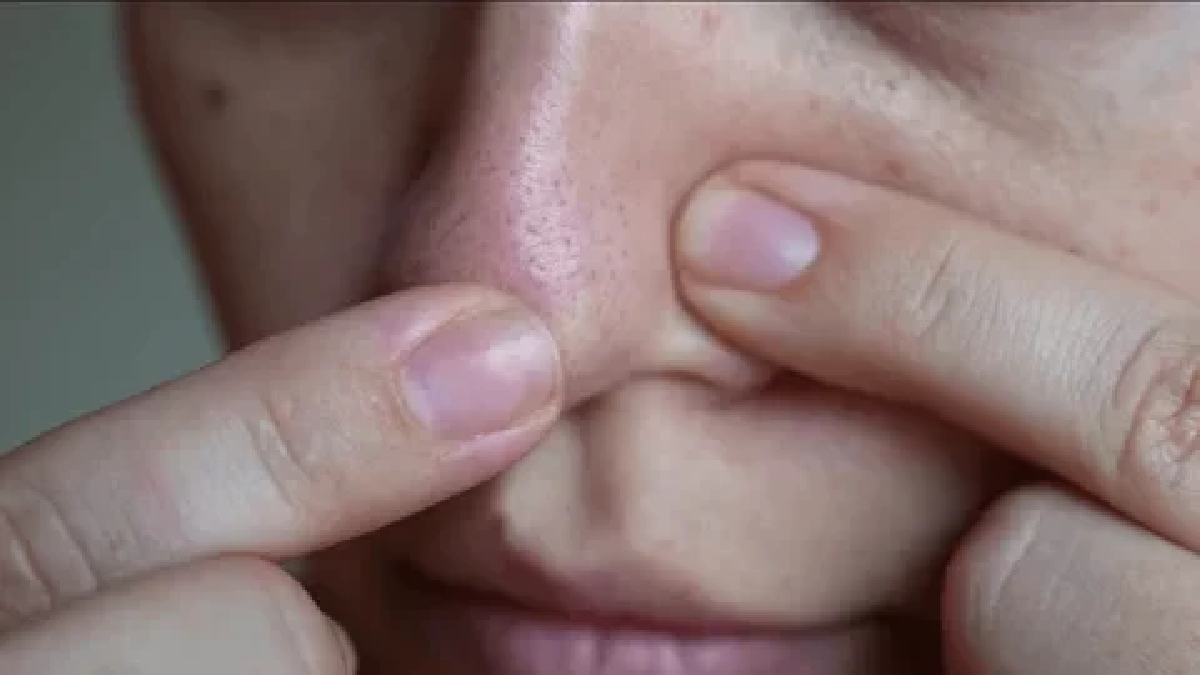 หมอเตือน! บีบสิวที่จมูก อาจทำให้สมองติดเชื้อ เสี่ยงเสียชีวิตได้