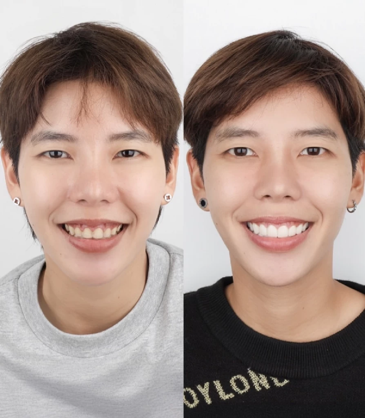 โดนบูลลี่มาทั้งชีวิต! \"ป๊ายปาย\" ยึดอกรับผ่าตัดเหงือก \"นุ๊ก ธนดล\" อวยยศ