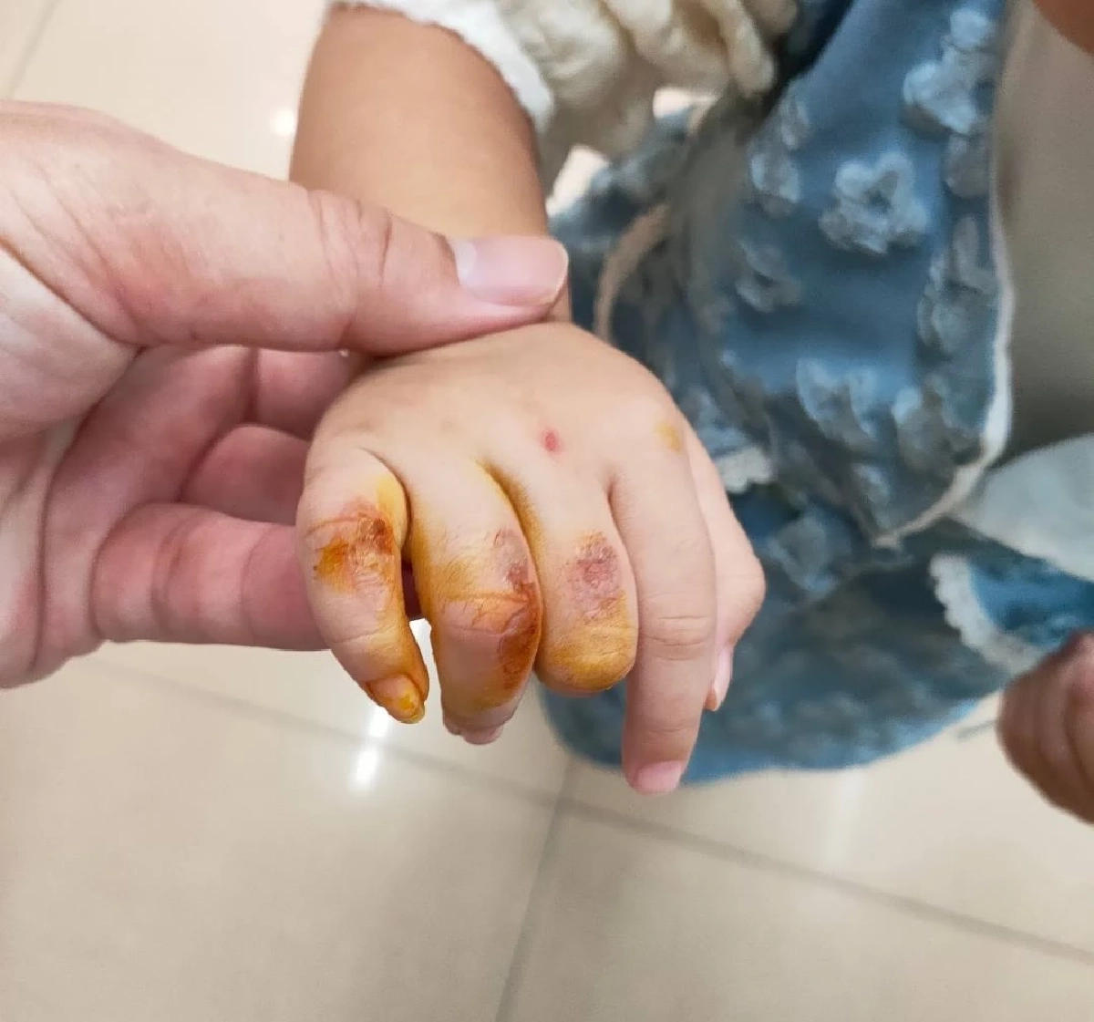 แม่โพสต์เตือน ลูกเล่น "เตารีดของเล่น" แต่ดันอยากจับของจริง ทำเกือบนิ้วขาด