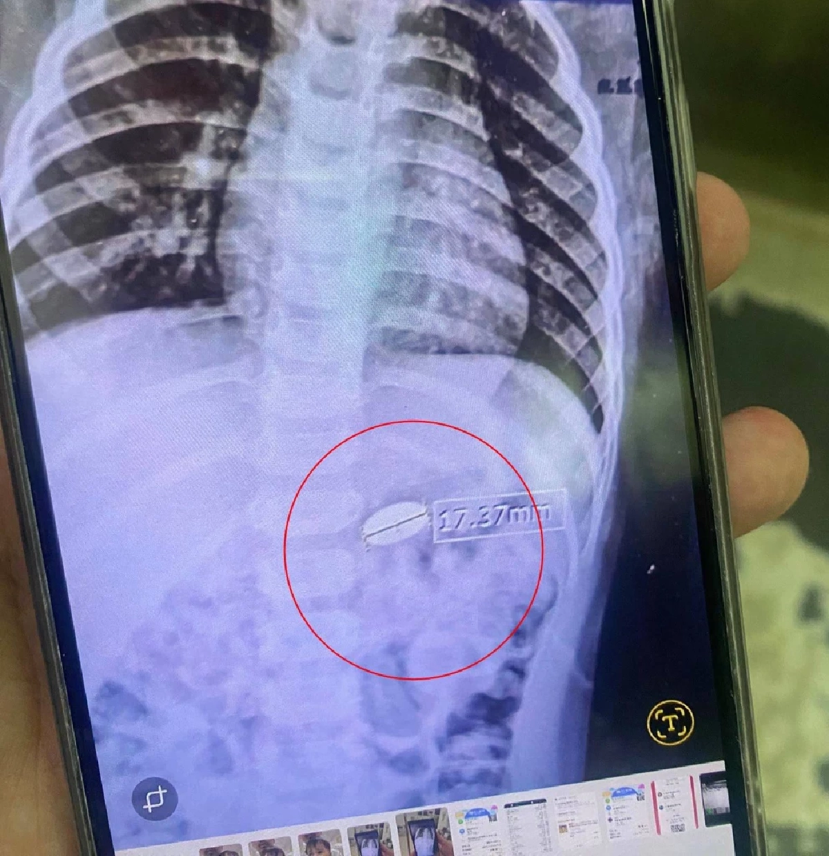 แม่โพสต์ บทเรียนชีวิต ลูกชาย กลืนเหรียญลงท้อง ยังรอขับถ่ายออกมา