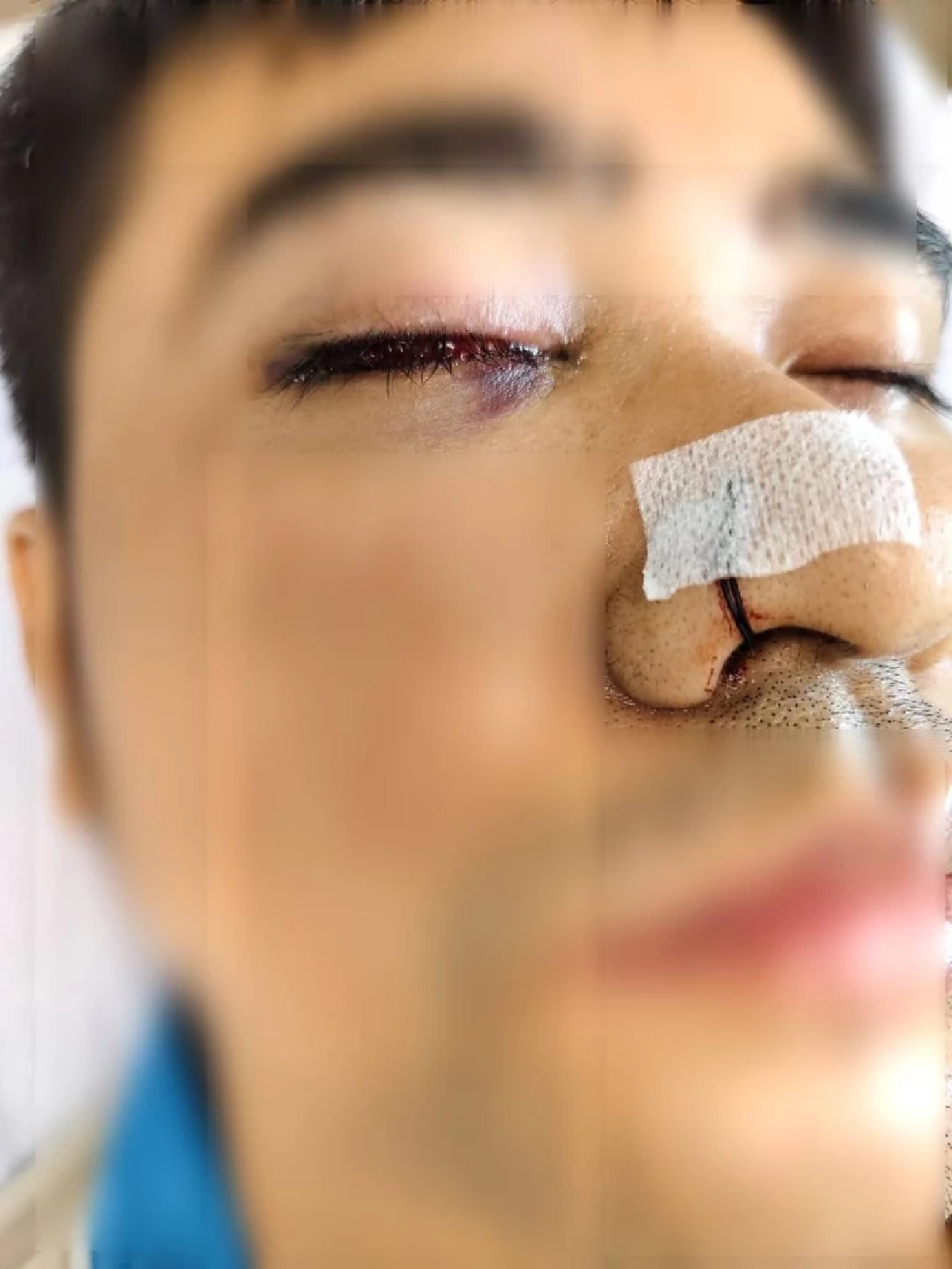 หนุ่มผ่าริดสีดวงจมูก พอฟื้นกลับมองไม่เห็น หมอพลาดตัดเส้นประสาทตา ไม่แจ้งญาติ