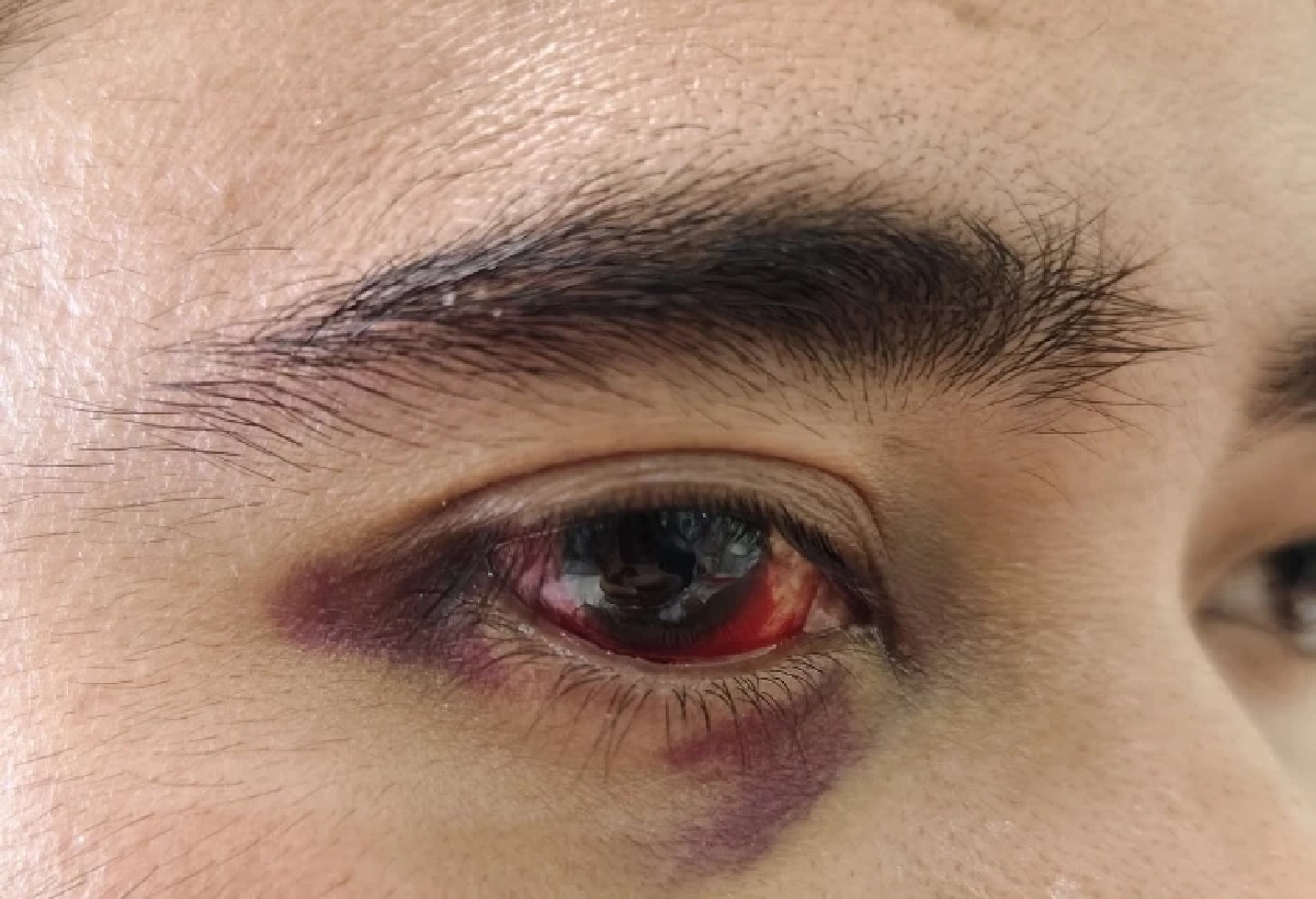 หนุ่มผ่าริดสีดวงจมูก พอฟื้นกลับมองไม่เห็น หมอพลาดตัดเส้นประสาทตา ไม่แจ้งญาติ