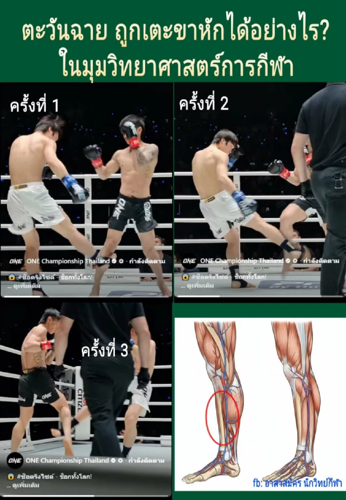 เพจดัง เปิดเหตุผลทำไมแค่เตะตัดขา ตะวันฉายถึงขั้นขาหัก?
