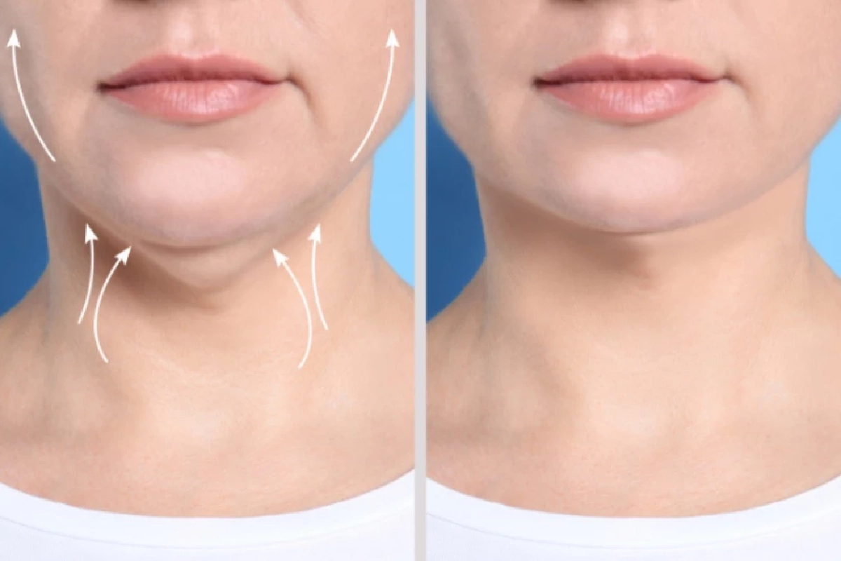 เหนียงคืออะไร? ทำไมหลายคนถึงมีเหนียงแม้น้ำหนักไม่เยอะ