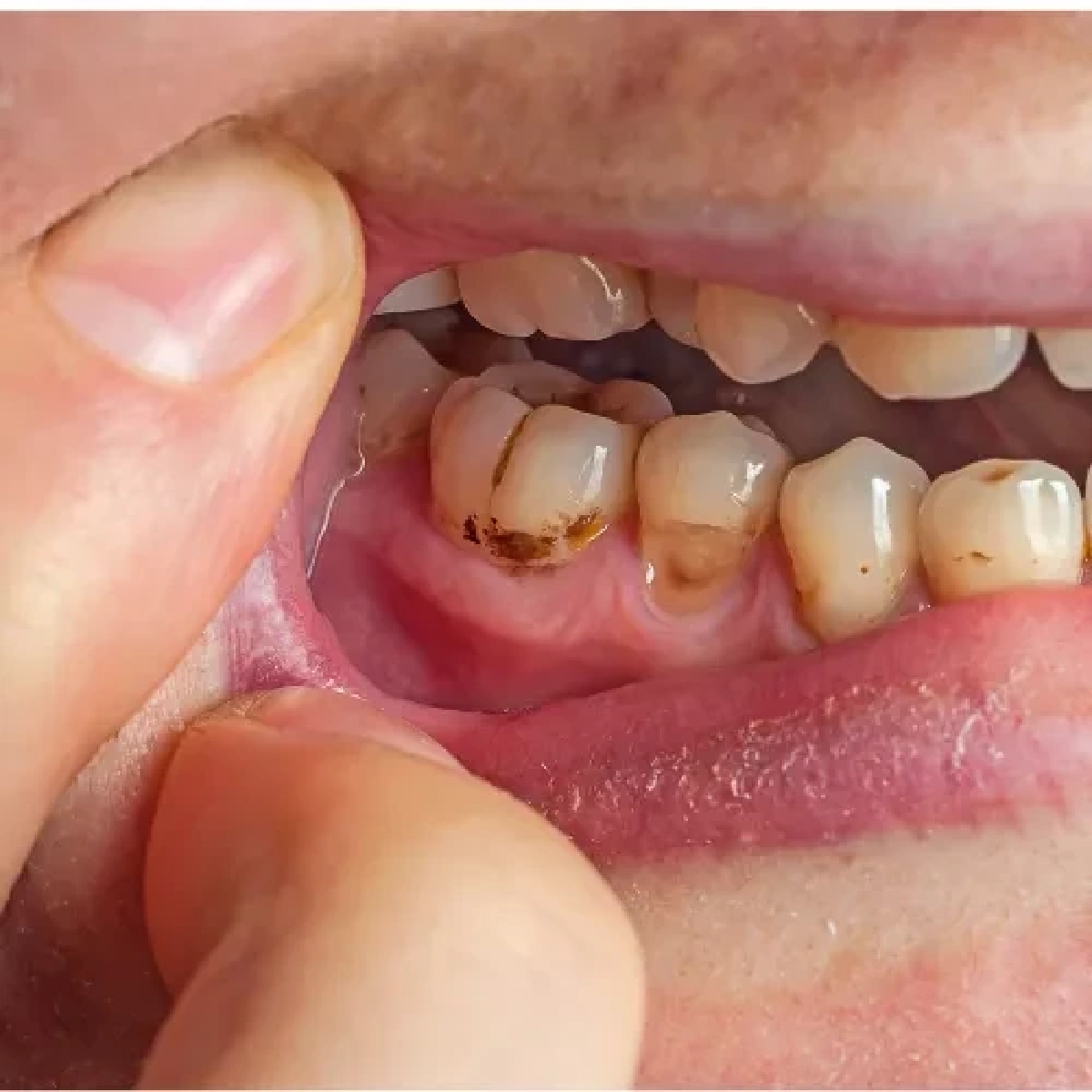 อย่าปล่อยให้ "หินปูน" ยึดปาก! ภัยเงียบทำฟันโยก-เหงือกร่น