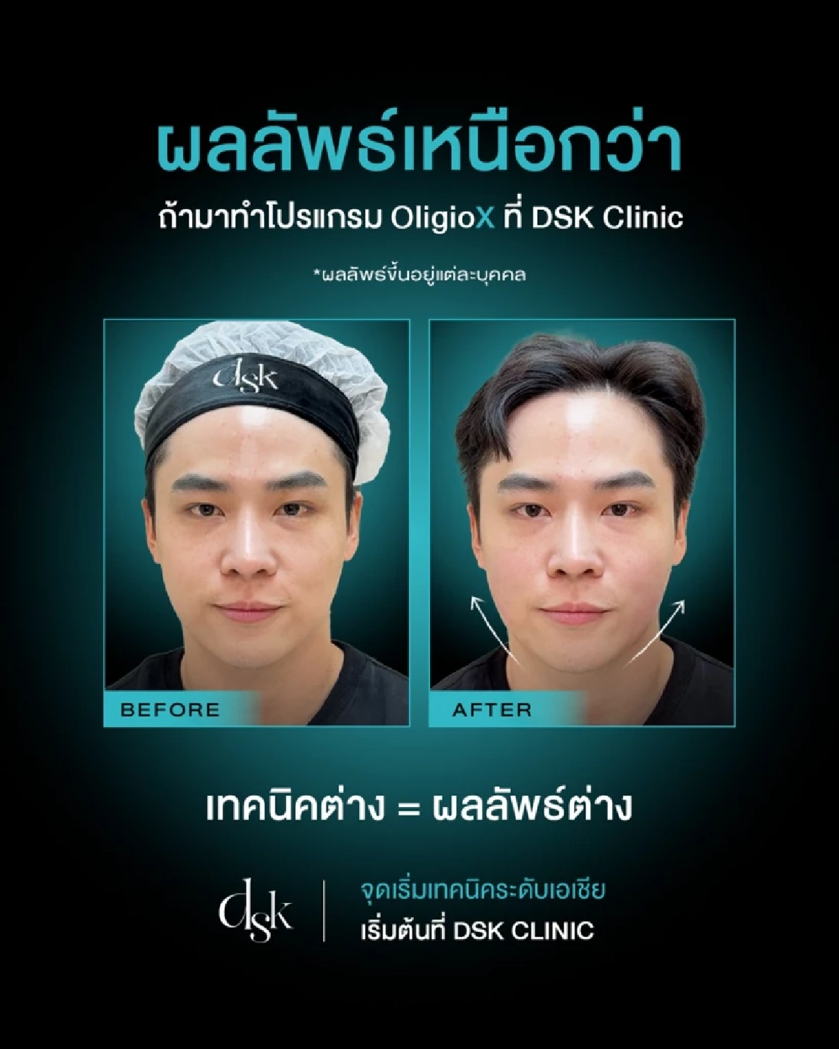 ยกระดับการยกกระชับ! ด้วยเทคนิค UltraSee จาก DSK Clinic ที่สแกนชั้นผิวจริงก่อนทำโปรแกรม OligioX 