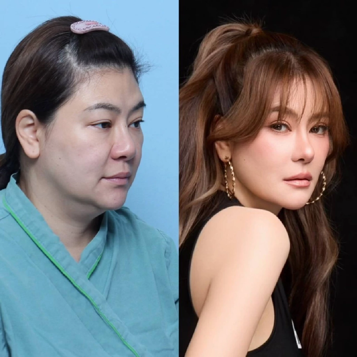 "โอ๋ ภัคจีรา" เปิดเบื้องหลัง ทำศัลยกรรม 6 จุด สวยย้อนวัย 10 ปี